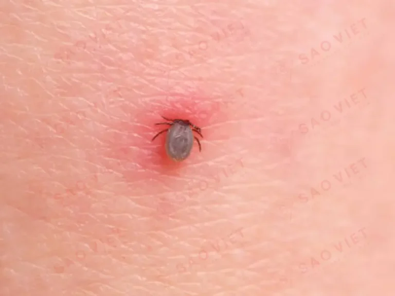 Con mò đỏ, bệnh sốt ve mò & Cách phòng ngừa) 3 Vết đốt của con mò đỏ